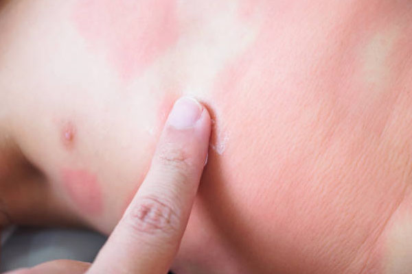 Eczema Relief: Discovering Effective Treatment Options