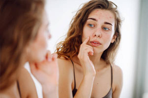What Kills Off Acne? Unveiling Effective Strategies for Clear Skin