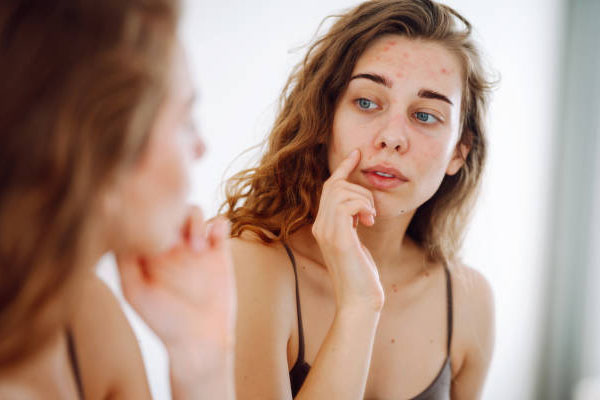 What Kills Off Acne? Unveiling Effective Strategies for Clear Skin
