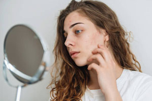 How to Get Rid of Acne in 3 Days Naturally: Quick Solutions